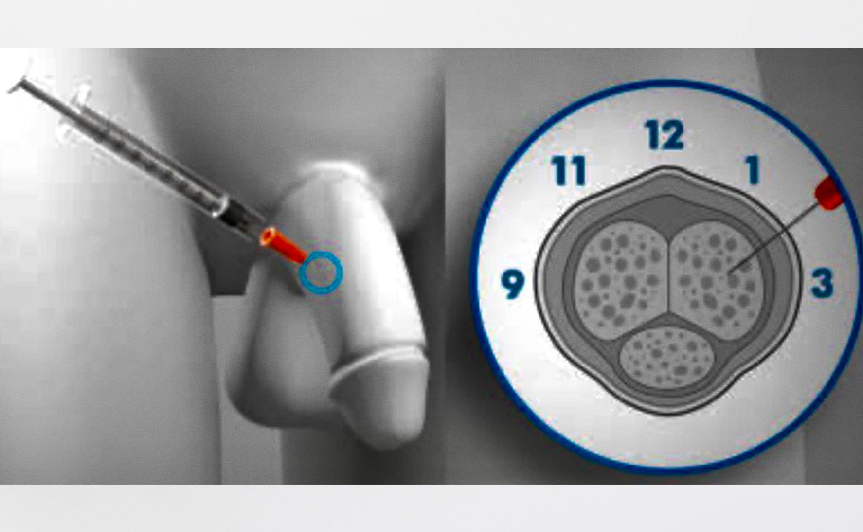 Injeção peniana: um tratamento muito eficaz e seguro para a disfunção  erétil - Urologista em Brasília - Dr. Homero Ribeiro